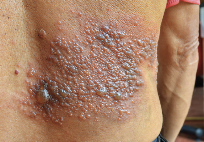 Phytotherapeutic approaches in Ayurveda for herpes simplex virus–associated dermatological lesions
